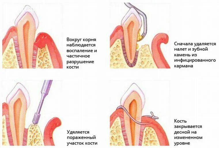 Сколько отходит зуб после анестезии