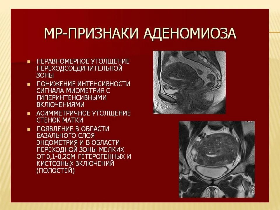 Диагностические критерии аденомиоза. Мрт эндометрия