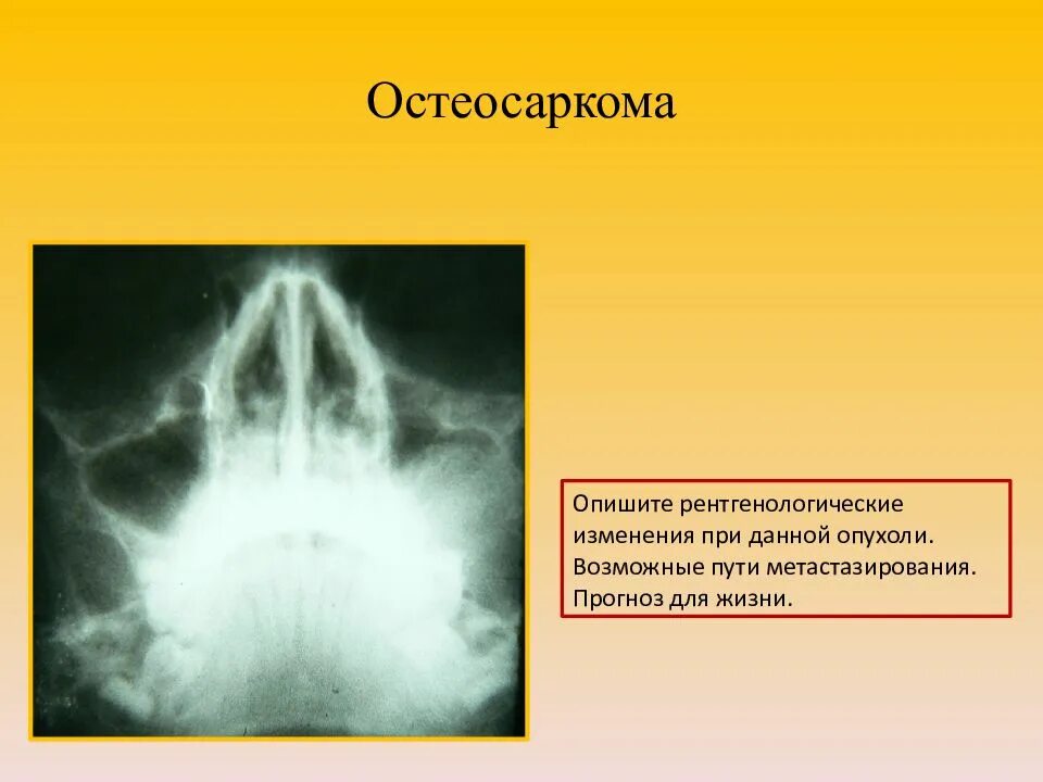 Остеосаркома прогноз. Остеосаркома пути метастазирования. Остеосаркома этиология. Путь метастазирования при остеосаркоме. Конвенциональная остеосаркома что это.