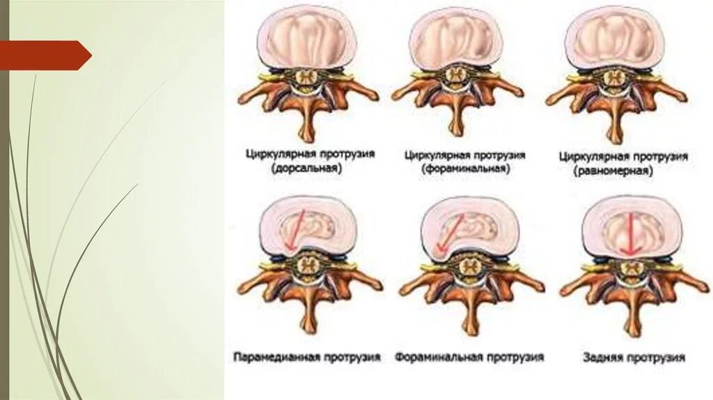 Экструзия дисков шейного отдела позвоночника