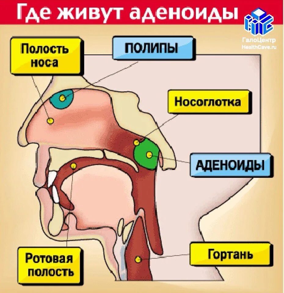 Где находится детское. Строение носоглотки аденоиды. Анатомия носоглотки аденоиды. Строение горла аденоиды. Аденоиды у дошкольников.