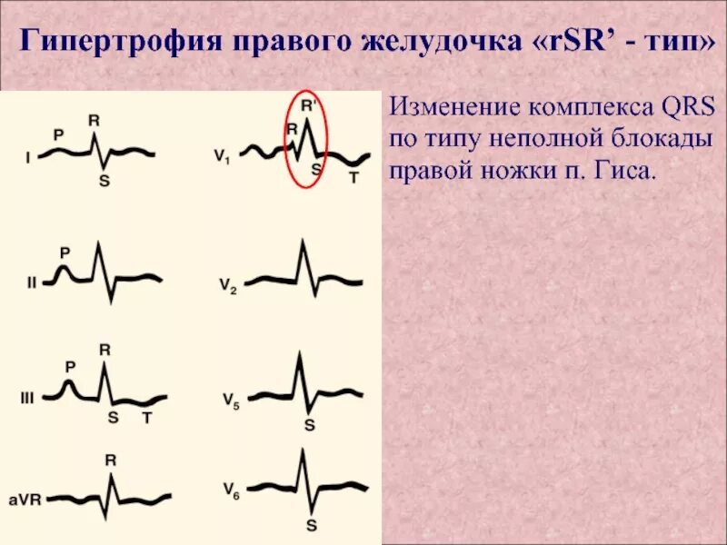 Типы гипертрофии правого желудочка на ЭКГ. Правожелудочковая гипертрофия ЭКГ. Признаки гипертрофии правого желудочка на ЭКГ. ЭКГ признаки гипертрофии правого желудочка на ЭКГ. Блокада правой ножки желудочка