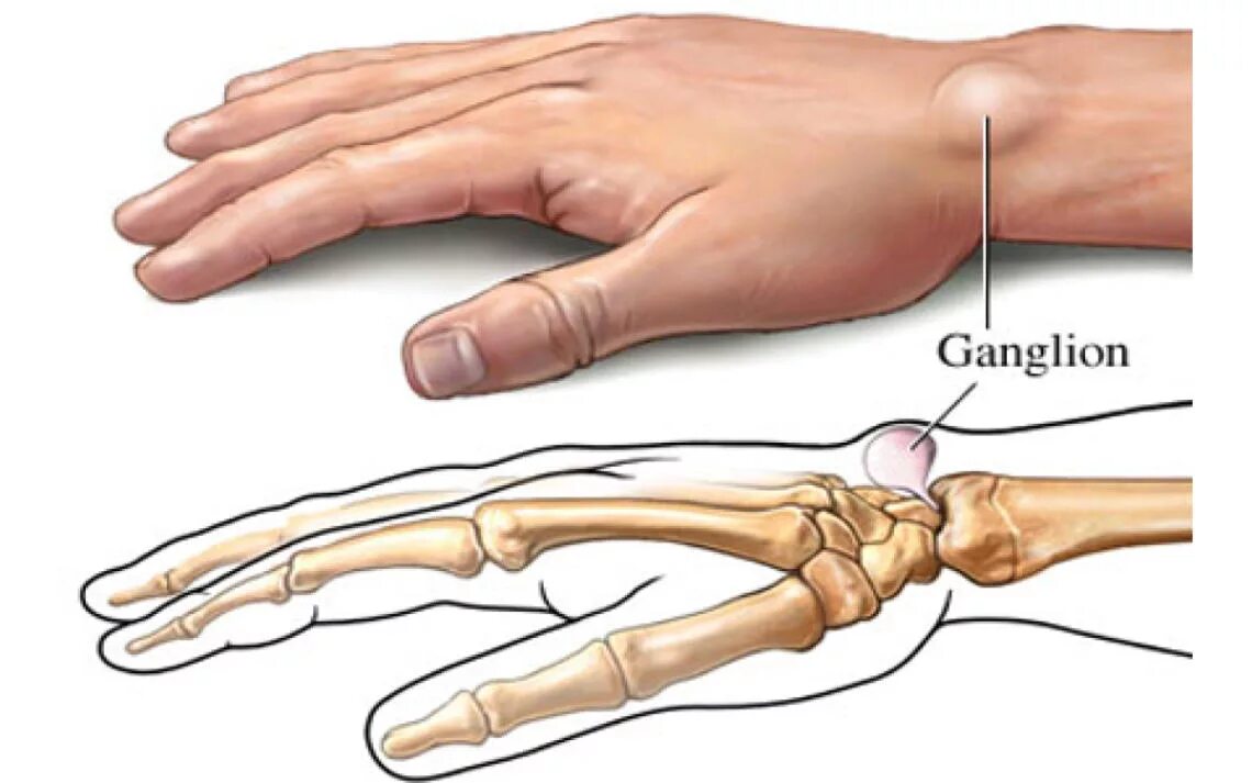 Что представляет собой ганглий. Гигрома сухожильный ганглий. Гигрома лучезапястного сустава. Ганглион лучезапястного сустава. Стенозирующий лигаментит.