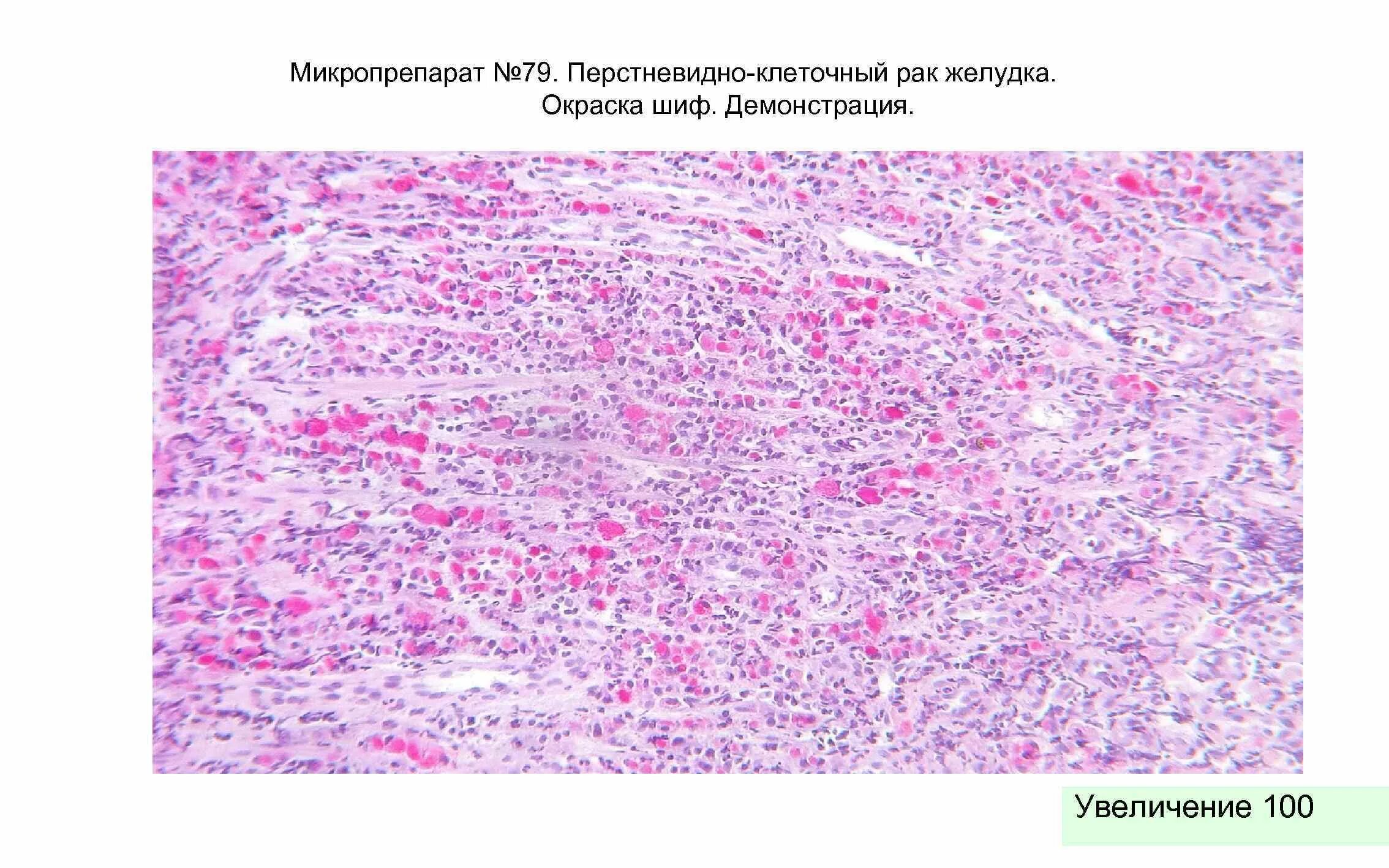 Перстневидноклеточная карцинома желудка микропрепарат. Опухоли желудка Макропрепараты. Перстневидноклеточная карцинома желудка патанатомия. Язва-рак желудка микропрепарат.