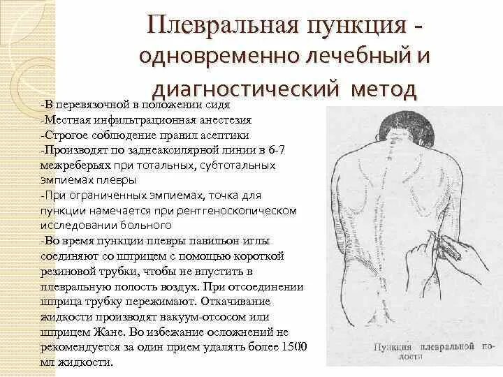 Техника выполнения плевральной пункции