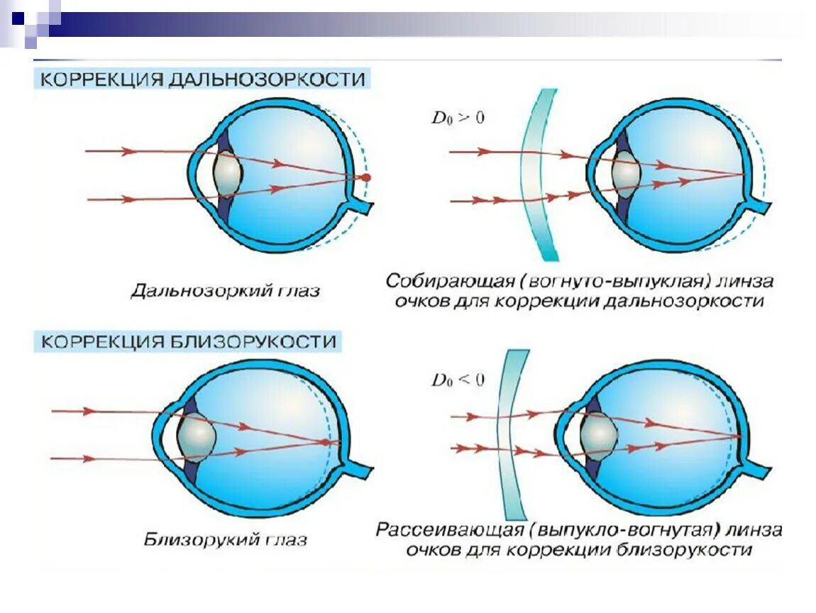 Линзы в глаза операция