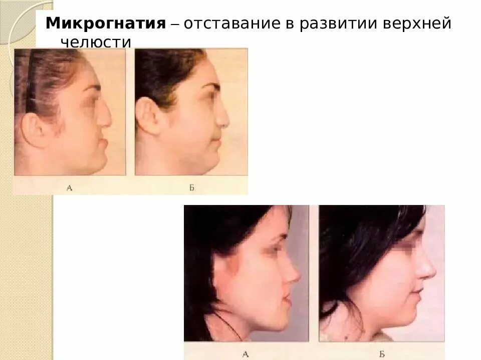 Микрогнатия верхней челюсти фото