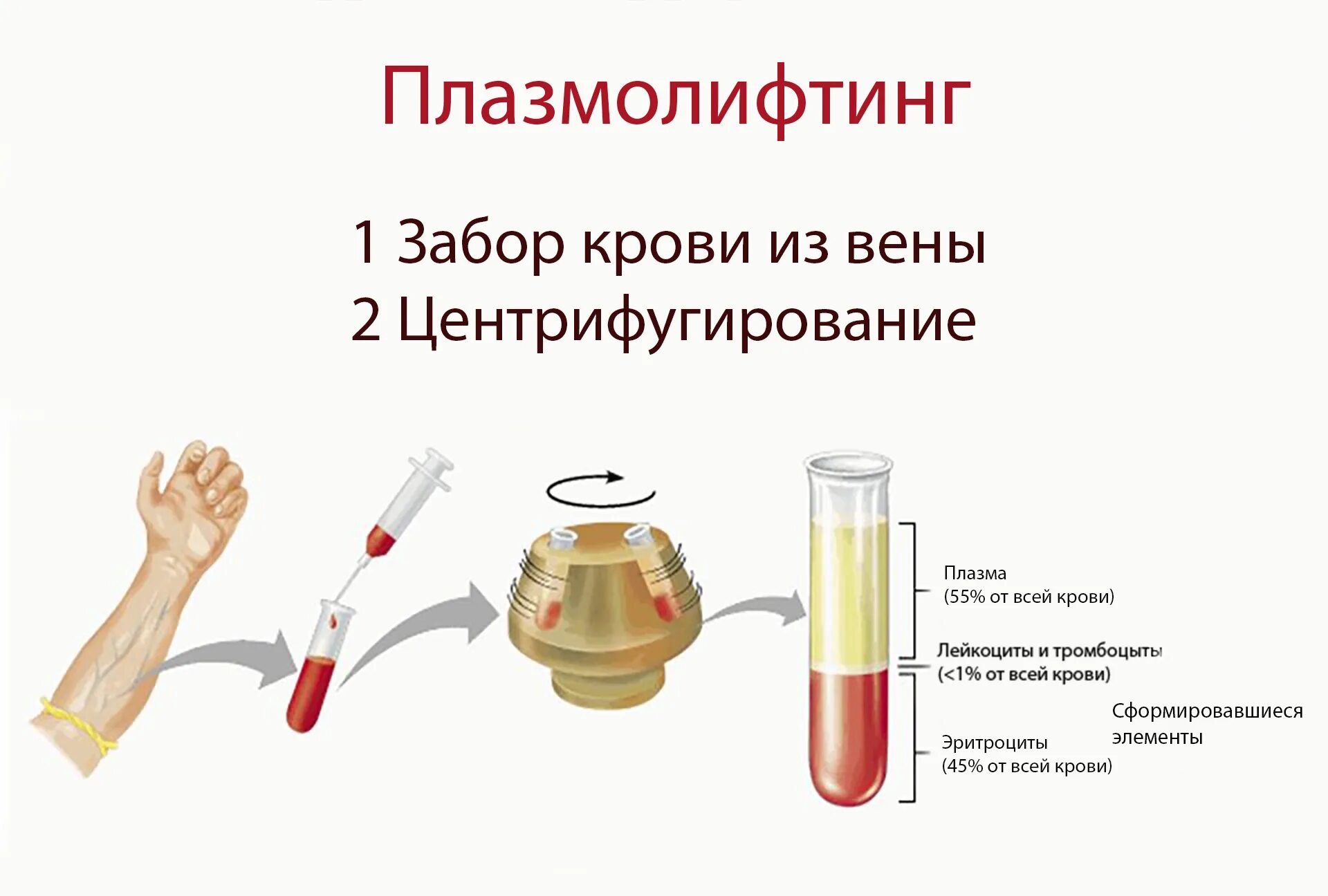 Плазмолифтинг протокол проведения. Введение плазмы обогащенной тромбоцитами. Плазмолифтинг этапы процедуры. Плазма крови в лицо