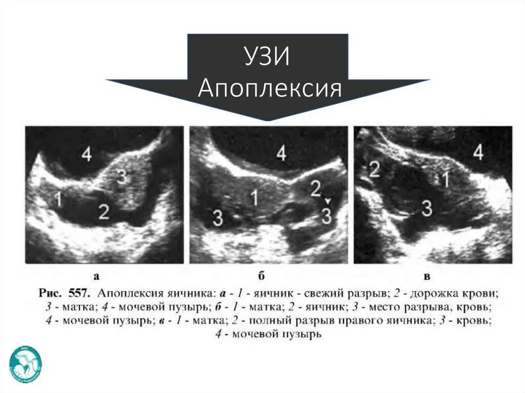 УЗИ диагностика апоплексии яичника. УЗИ признаки апоплексии яичников. Апоплексия яичника УЗИ картина. Апоплексия яичника и перитонит.