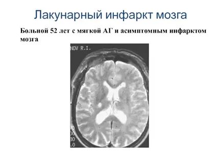 Лакунарная киста головного мозга