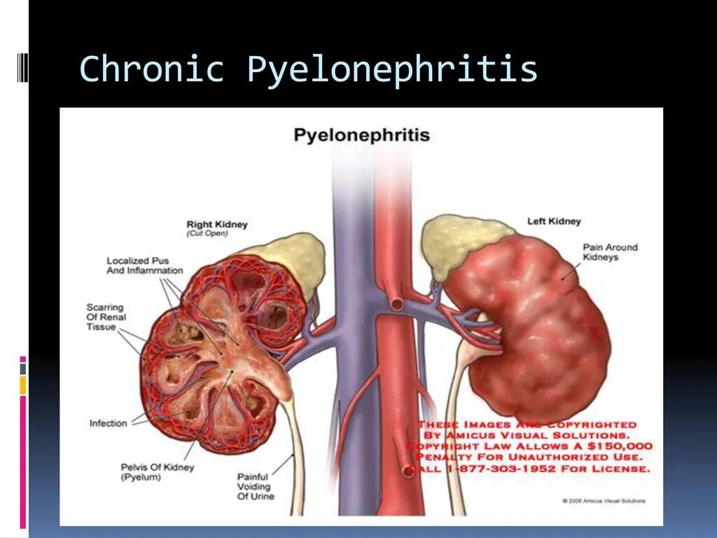 Воспаление почечных лоханок пиелит. Строение почки пиелонефрит. Пневмония пиелонефрит