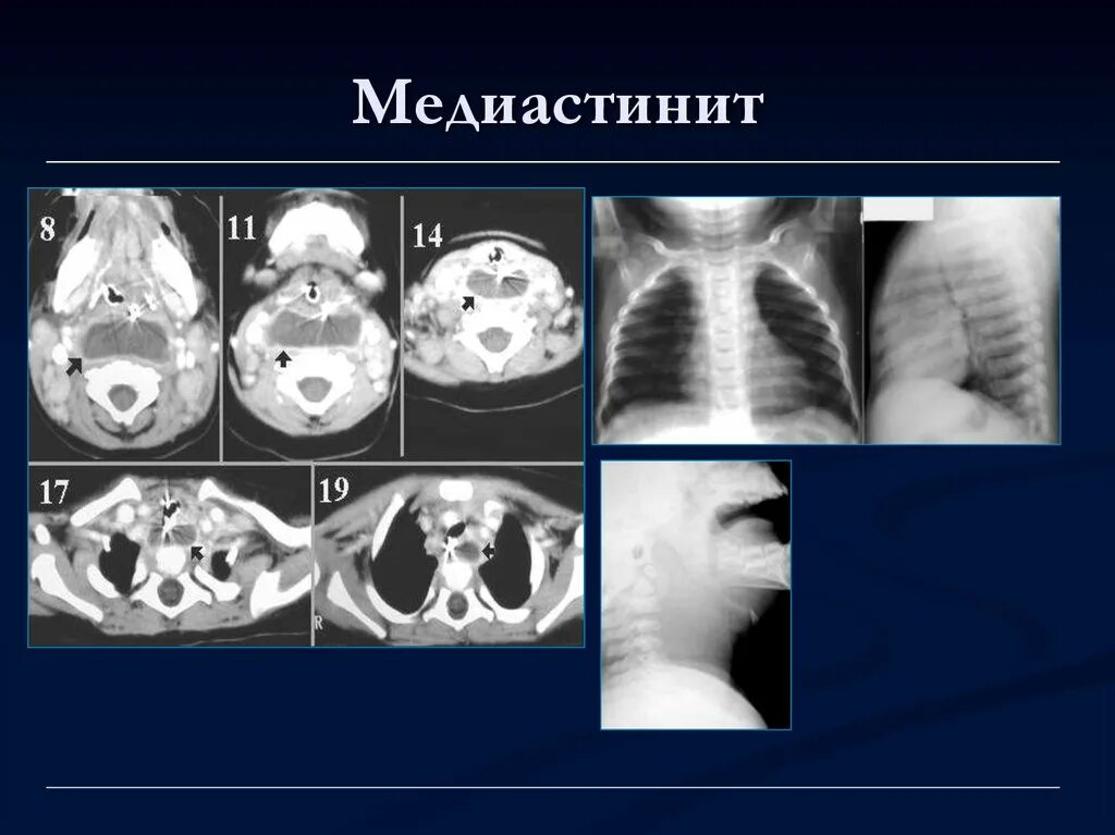 Передний медиастинит рентген. Фиброзирующий медиастинит. Передний Гнойный медиастинит. Гнойный медиастинит рентген. Гнойный медиастинит