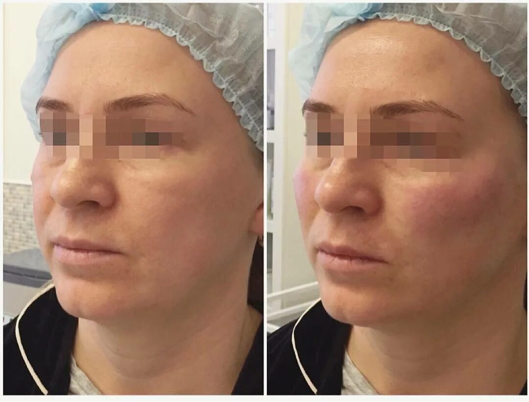 эндоскопический лифтинг лица. биоармирование векторный лифтинг. волюмайзер radiesse. радиесс от малярных мешков. векторный лифтинг в косметологии.