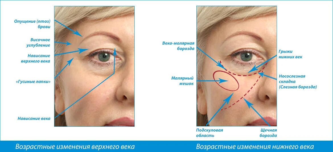 Блефаропластика птоз верхнего века. Верхняя блефаропластика схема. Блефаропластика верхних век схема. Птоз без операции