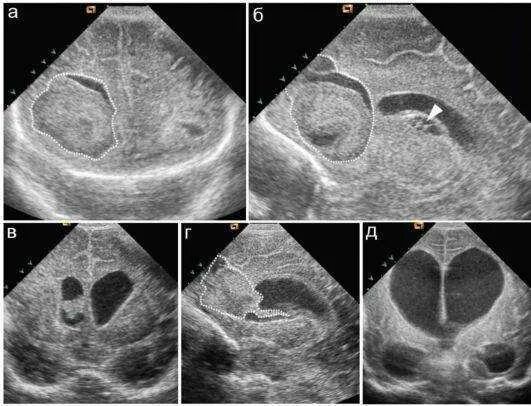 Субэпендимальная киста на УЗИ. Субэпендимальная киста головного мозга. Субэпендимальная киста головного мозга у новорожденного. Хориоидальная псевдокиста.