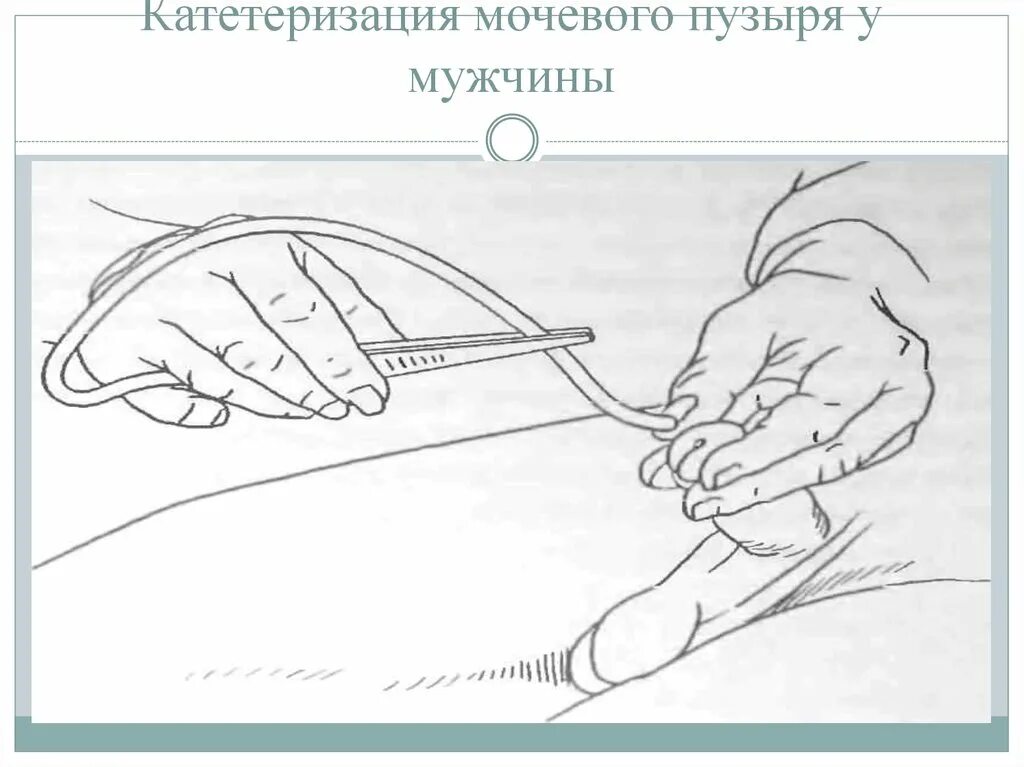 Алгоритм введения катетера. Схема катетера для мочевого пузыря. Алгоритм постановки мужского мочевого катетера. Мочевой катетер для женщин мужчин алгоритм. Схема установки катетера в мочевой пузырь.