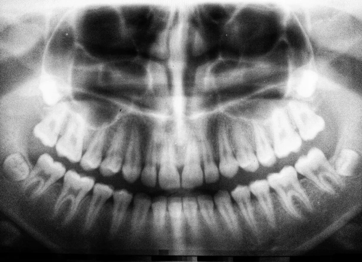 Снимок. Рентген зубов панорамный снимок. Панорамные снимки зубов. Обзорная рентгенография зубов.