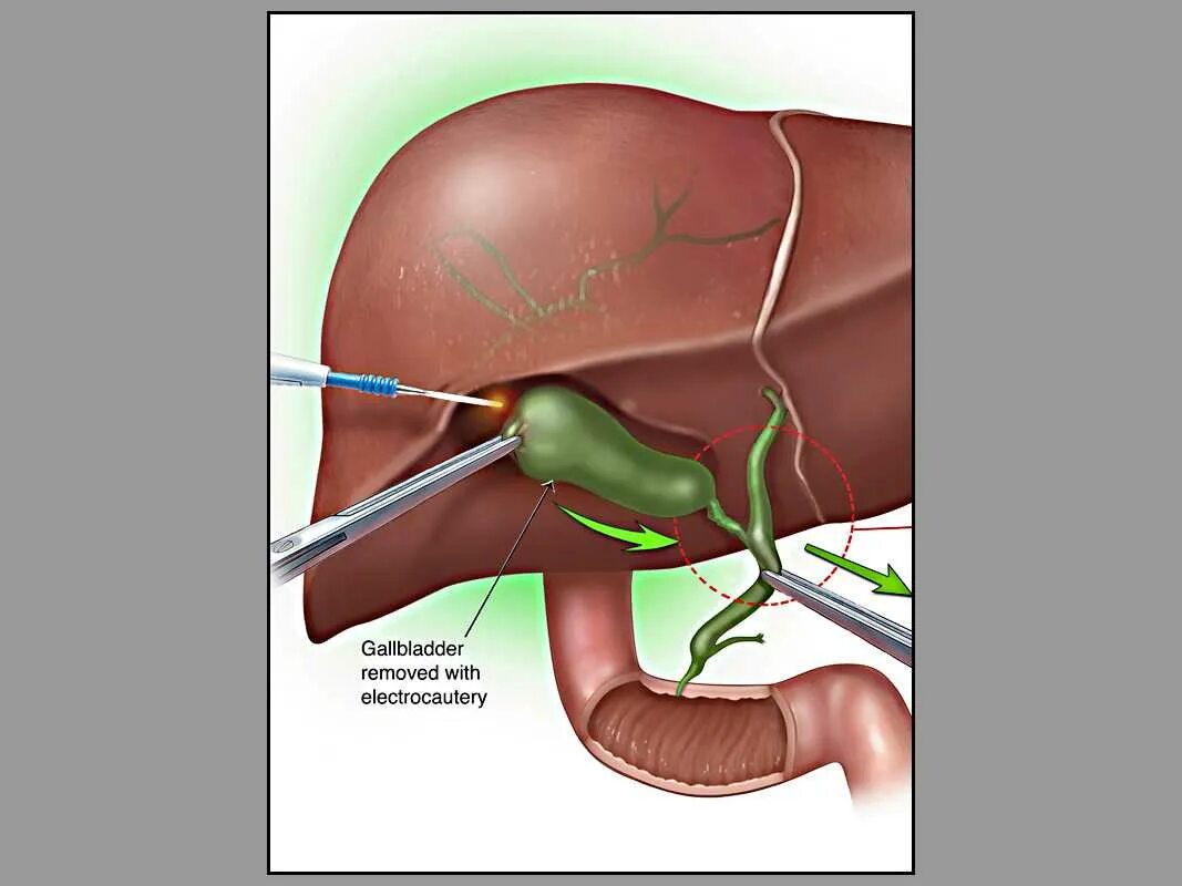 Что будет если удалить желчный пузырь. Холецистэктомия желчного пузыря лапароскопическая. Лапаротомия холецистэктомия. Желчный лапароскопия дренаж. Холецистэктомия анатомия.