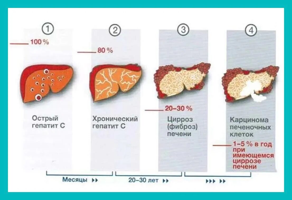 Может ли уменьшиться печень. Хронический гепатит б цирроз печени. Этапы поражения печени при гепатите с. Цирроз печени стадии гепатит с.
