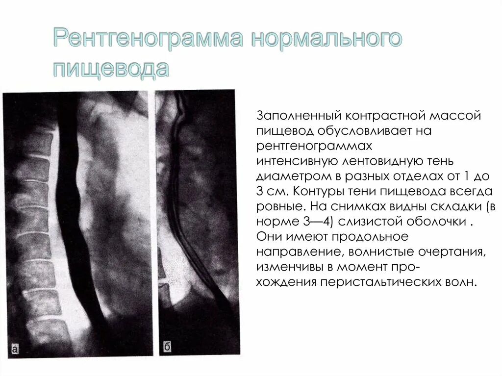 Рентгенограмма нормального пищевода. Тень пищевода на рентгенограмме. Патологии пищевода на рентгенограмме. Рентгенограммы контрастного исследования пищевода,.