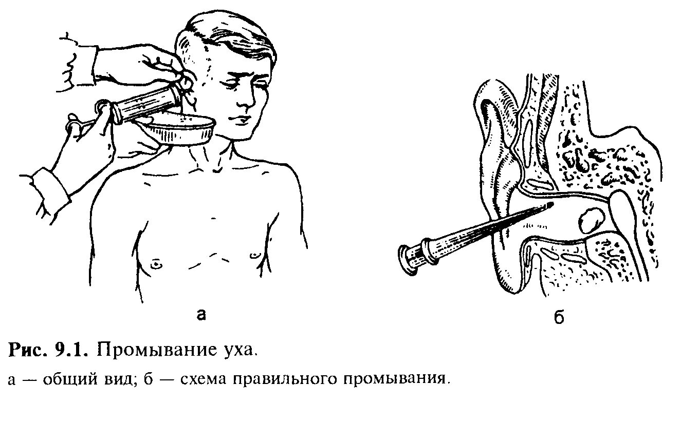 Шприц для промывания серных пробок. Шприц жане промывание серной пробки. Техника промывания наружного слухового прохода. Промывание ушей алгоритм. Как промыть ухо водой