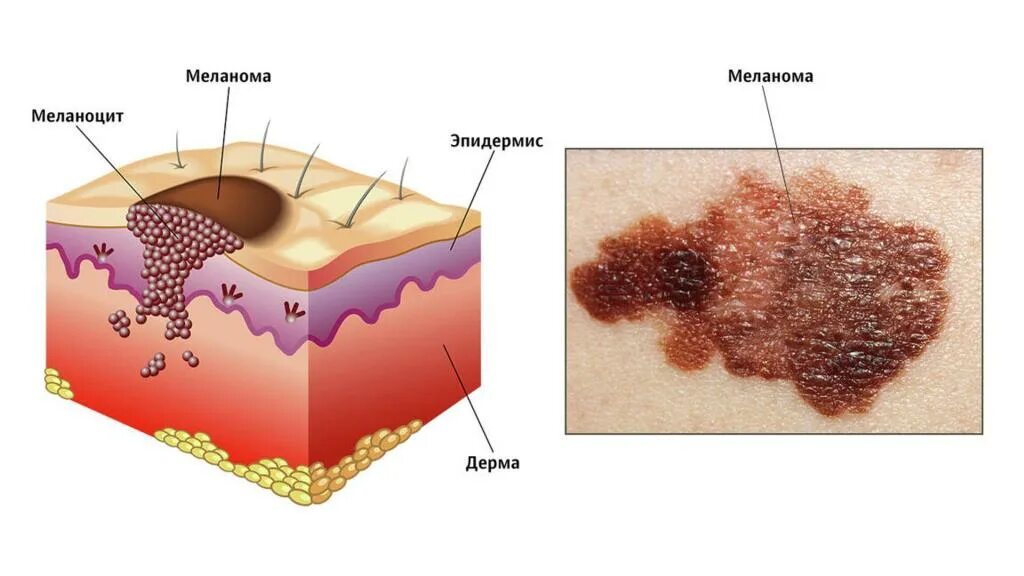 Амеланотическая злокачественная меланома. Базальноклеточный (базалиома).. Внутридермальный пигментный невус. Фиброзирующая базалиома. Родинка сюжет кратко