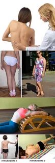 Пресс при сколиозе