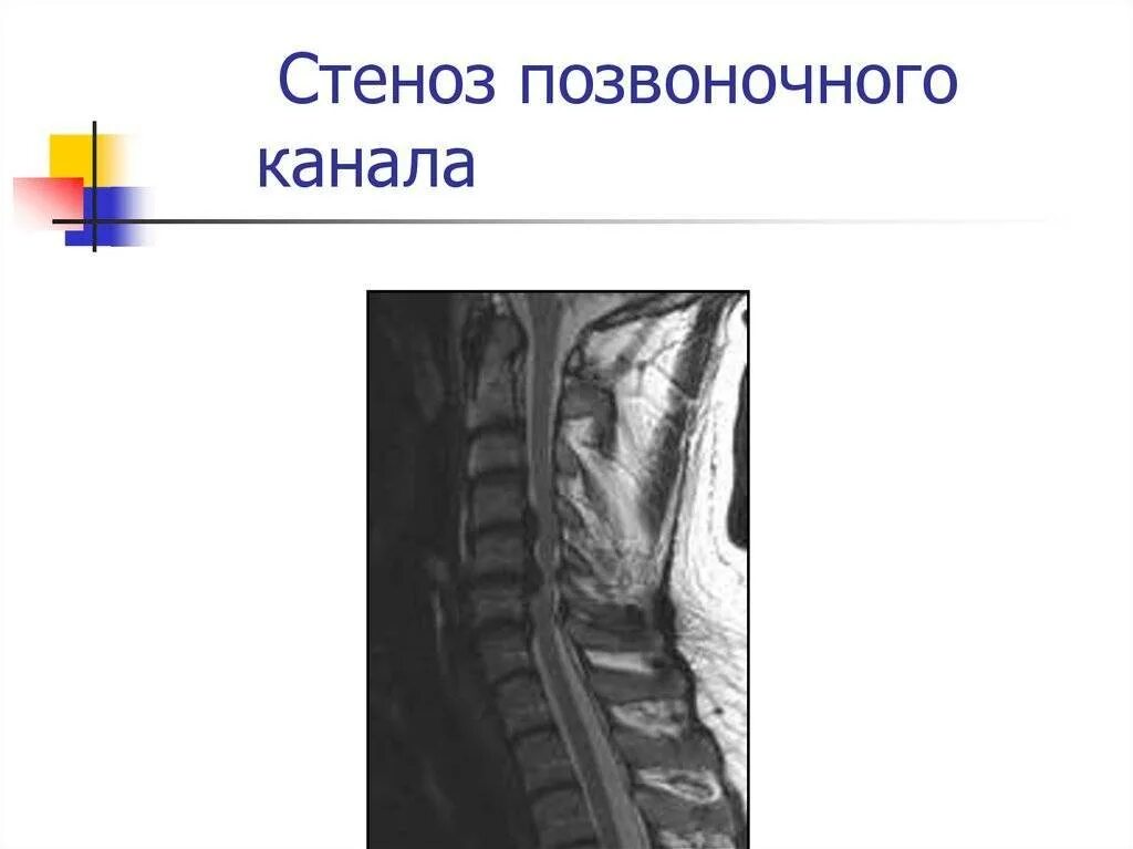 Поясничный абсолютный стеноз. Стеноз позвоночного канала л3 л5. Спинальный стеноз л5с1. Сужение позвоночного канала поясничного отдела мрт. Люмбальный стеноз позвоночника.