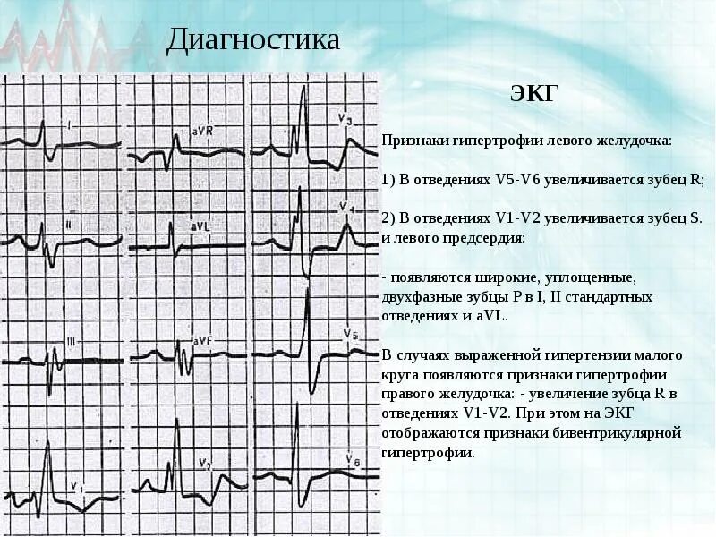 Глж на экг. Гипертрофия миокарда левого желудочка на экг. заключение экг при гипертрофии левого желудочка. признаки гипертрофии лж на экг. гипертрофия левого желудочка экг зубец r.