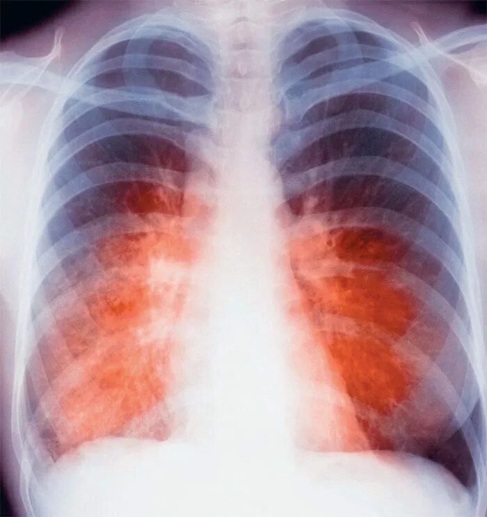 Частые болезни легких. Лёгкие человека туберкулез. Легкие больного туберкулезом. Открытая форма туберкулеза.