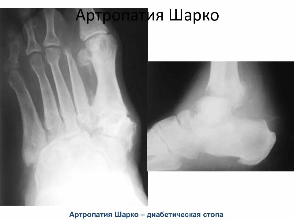 Диабетическая остеоартропатия (стопа Шарко). Диабетическая артропатия Шарко. Остеоартропатия Шарко.