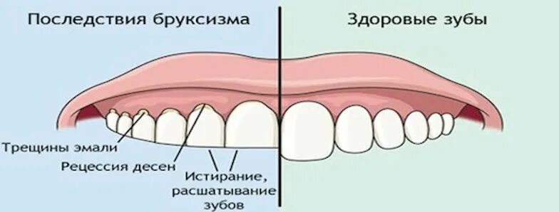 Почему щелкает зуб. Скрипение зубами во сне. Скрежет зубами во сне причины. Во сне скрипит зубами взрослый.