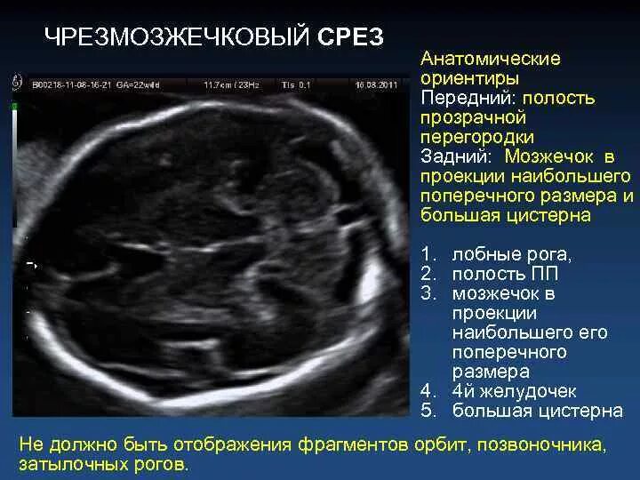 Строение головного мозга плода на УЗИ. Большая цистерна плода норма по УЗИ. Большая цистерна норма при УЗИ плода. Размер большой цистерны у плода по неделям на УЗИ.