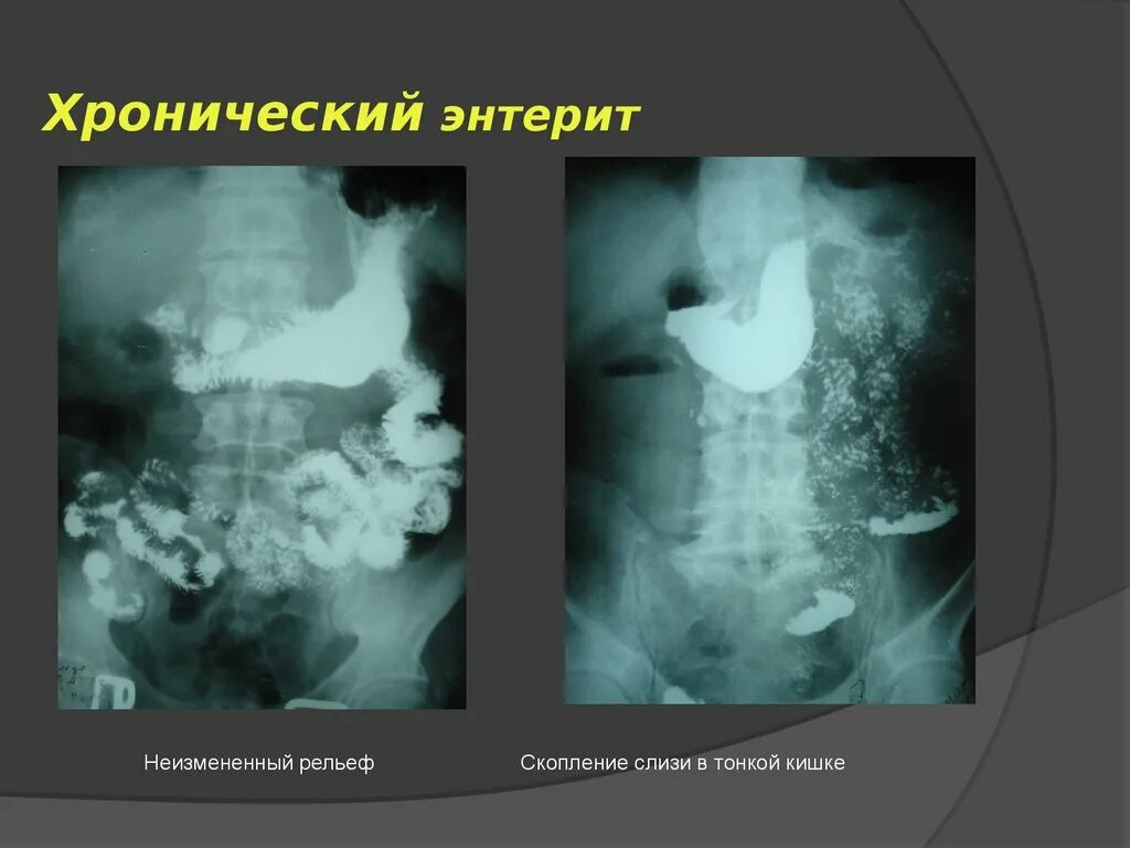 Энтерит симптомы у взрослых. Острый и хронический энтерит.
