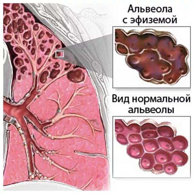 Буллёзная эмфизема лёгких мкб. Острая альвеолярная эмфизема легких Ветеринария. Альвеолярная эмфизема легких.