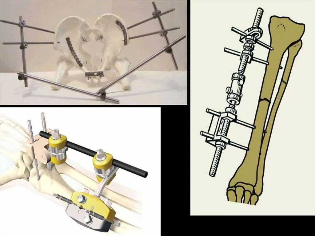4. Внеочаговый компрессионно-дистракционный остеосинтез.. Аппарат Kroner остеосинтез. Внеочаговый компрессионно-дистракционный остеосинтез челюсти. Оперативное лечение перелома костей