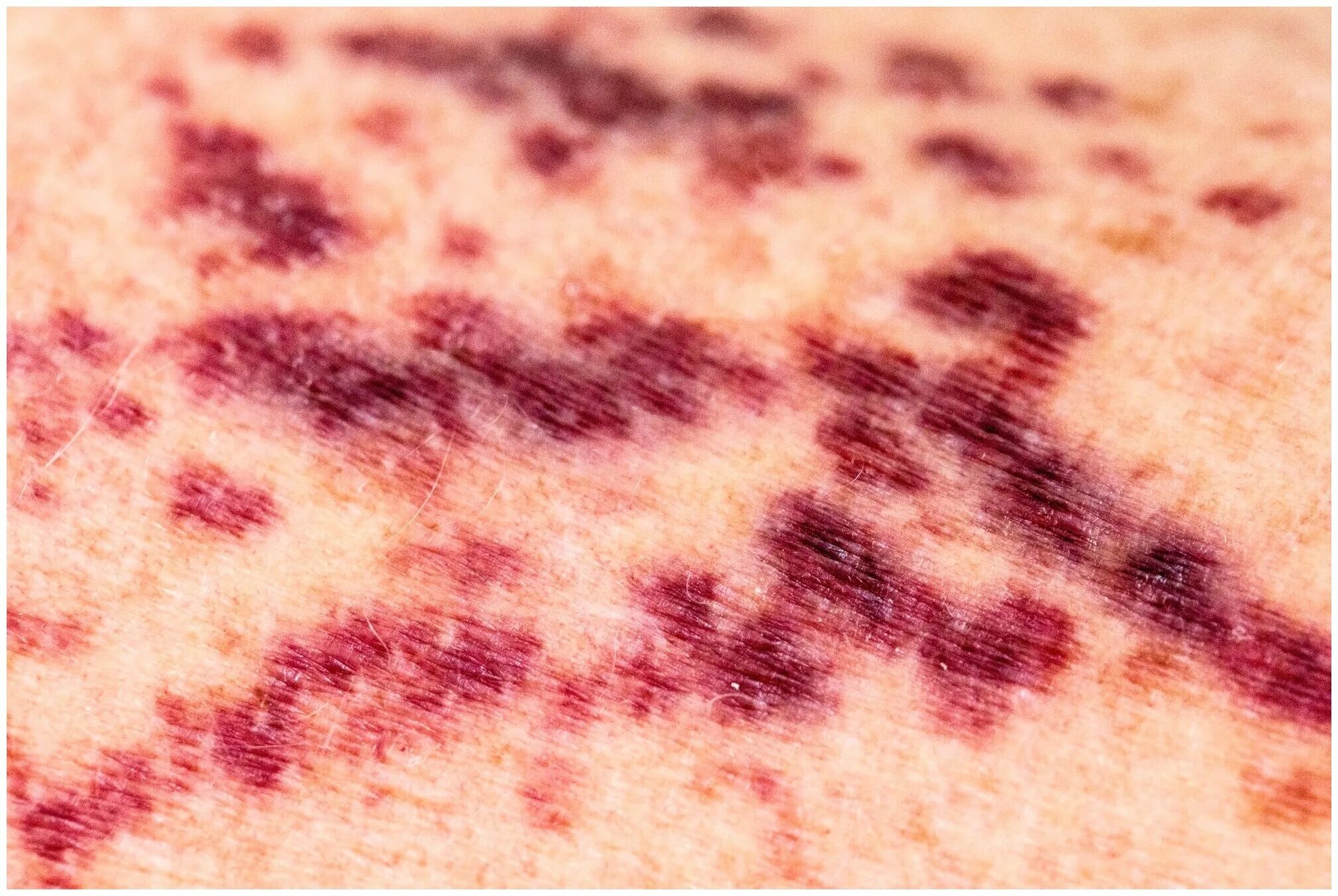 генезис александрии фиолетовые глаза. фиолетовый болезнь. пигментная пурпура шамберга. йод фиолетовый цвет. галлюциногены экстази.