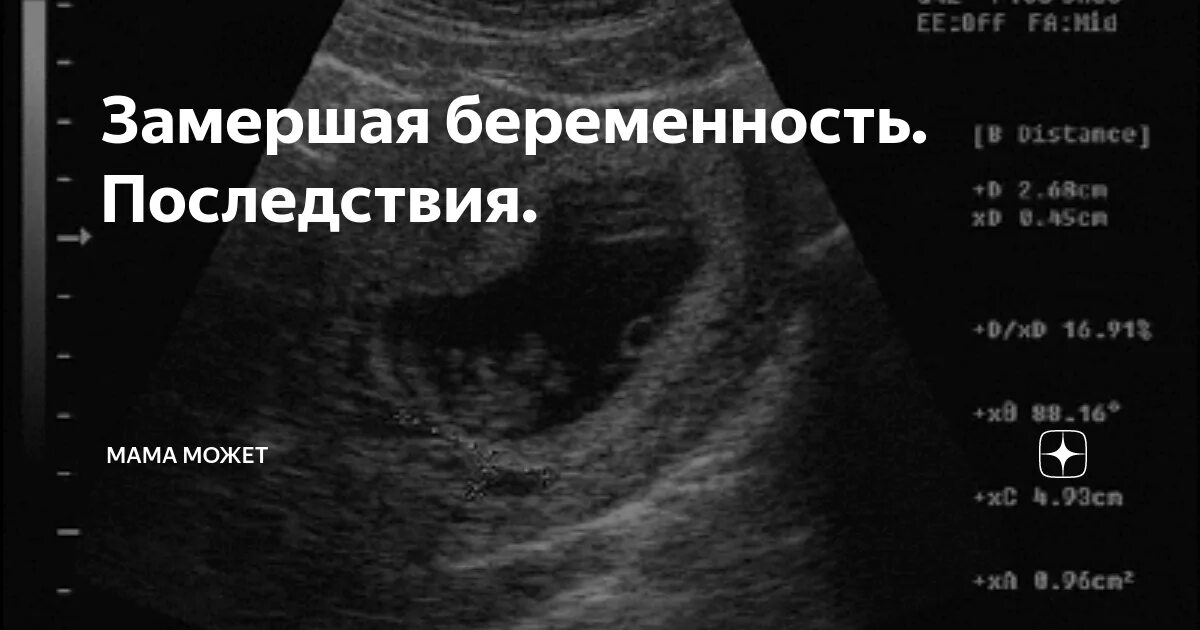 Замершая 14 недель. Вымершая беременности. Замершая беременность УЗИ. Проявления замершей беременности. Замершая беременность на маленьком сроке.