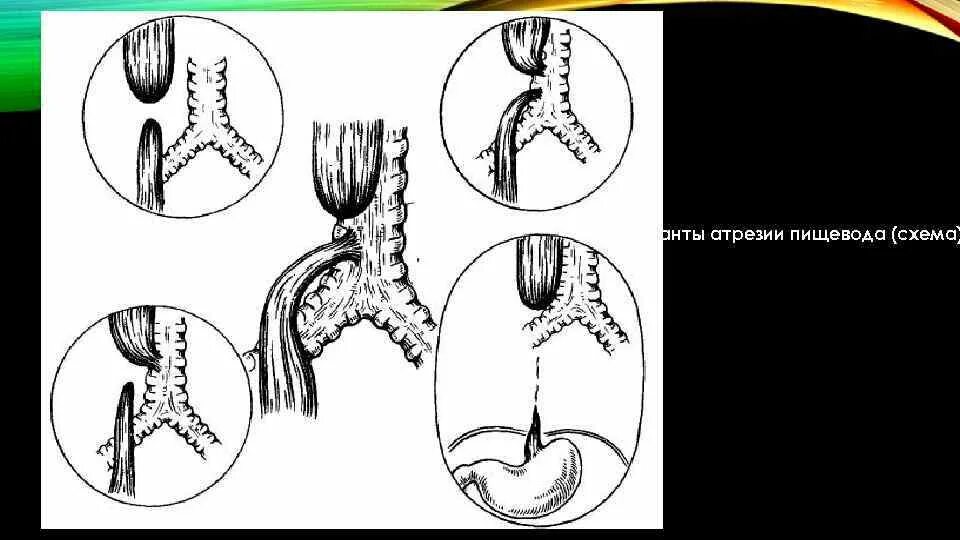 Отсутствие пищевода. Атрезия пищевода схема. Атрезия пищевода у новорожденных операция. Атрезия пищевода этиопатогенез. Врожденные аномалии развития пищевода хирургия.