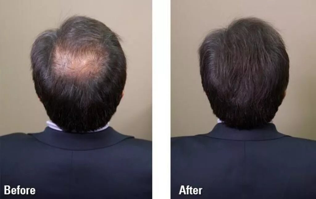 залысины на голове у мужчин. облысение макушки у мужчины. небольшая лысина на макушке. облысение макушки у мужчины. гнездная алопеция офиазис.