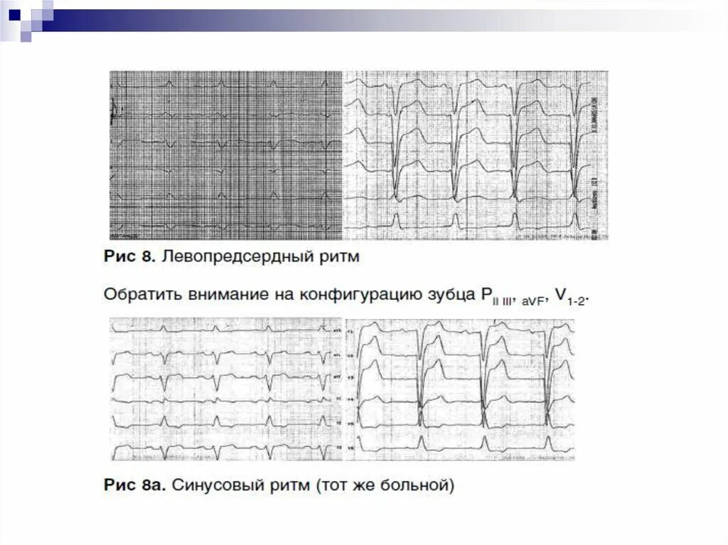 Эктопический предсердный ритм на ЭКГ. Нижнепредсердный ритм на ЭКГ. Эктопический нижнепредсердный ритм на ЭКГ. ЭКГ признаки левопредсердного ритма. Эктопический предсердный ритм что это
