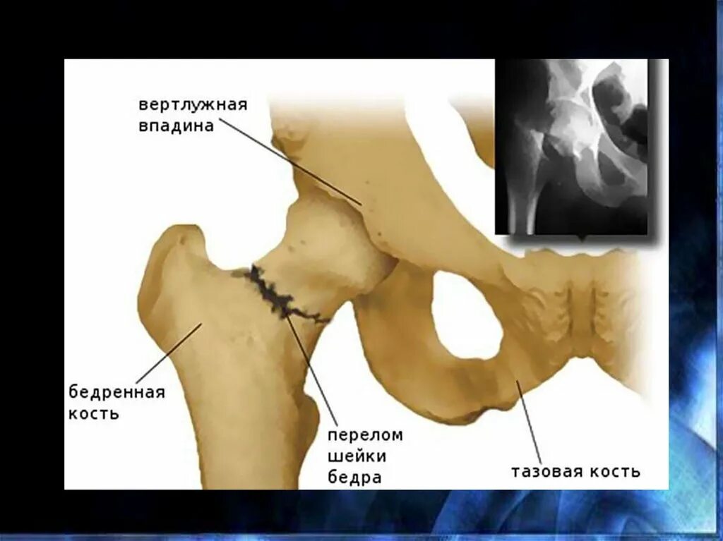 Последствия перелома шейки бедра. Вертлужный перелом шейки бедра. Шейка бедра вертлужная впадина. Изолированные переломы Вертелов бедренной кости. Изолированный перелом малого вертела бедренной кости.