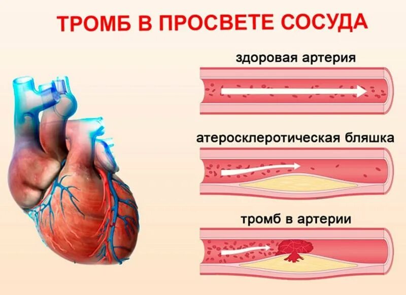 Сосудистые тромбы