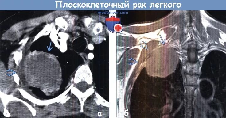 Плоскоклеточная карцинома легкого. Плоскоклеточная карцинома кт. )Плоскоклеточный опухоли легких. Стадии рака легких плоскоклеточный