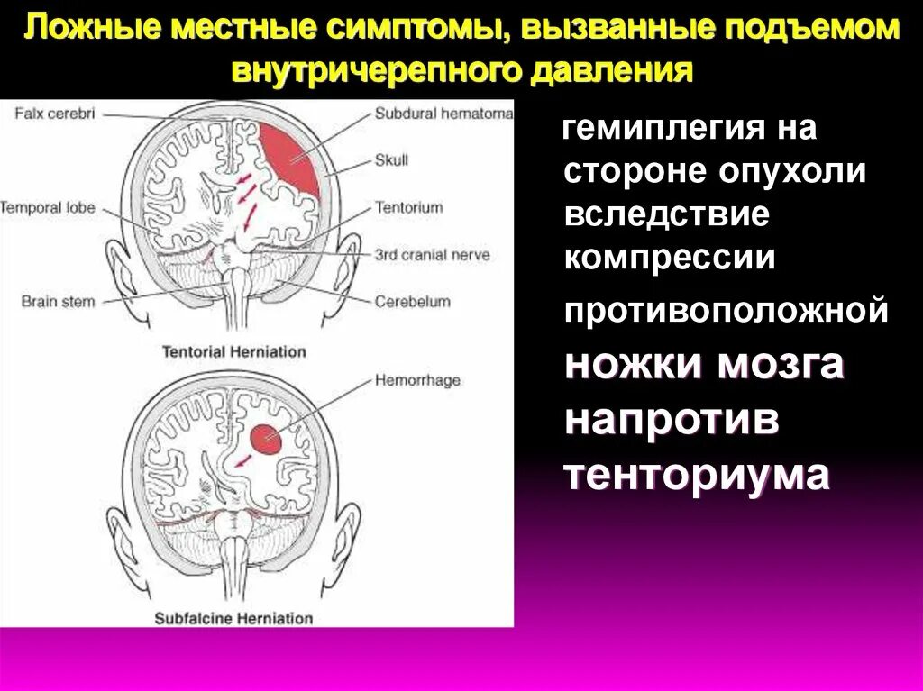 Опухоли головного и спинного мозга. Объемные образования головного и спинного мозга. Внутричерепное давление симптомы. Внутричерепная опухоль симптомы.