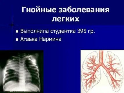 Инфекция легких
