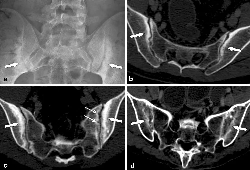 Сакроилеит крестцово-подвздошного сочленения рентген. Сакроилеит крестцово-подвздошного сочленения мрт. Мрт КПС (крестцово-подвздошных сочленений). Сакроилеит крестцово-подвздошного сочленения кт.