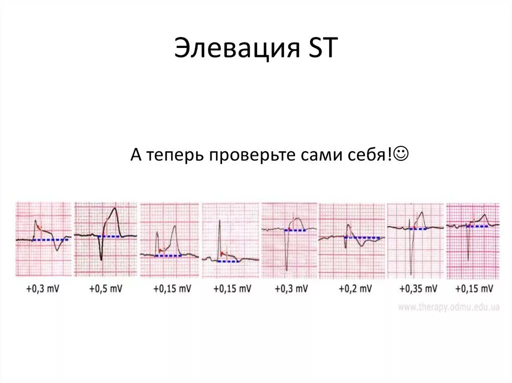 Эпизод депрессии st. Элевация St в грудных отведениях на ЭКГ. Элевация сегмента St. Элевация сегмента ст на ЭКГ. Элевация сегмента St на ЭКГ.