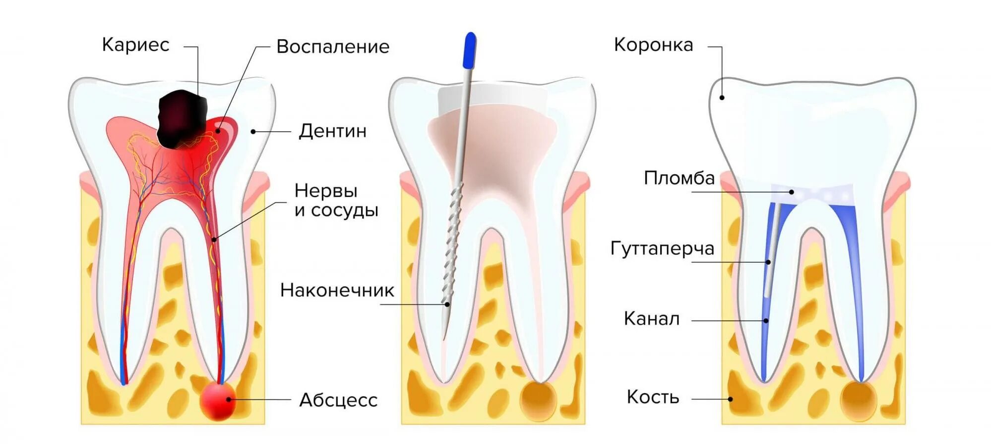 4 Канальный пульпит зуба. Пульпит 2 канального зуба.