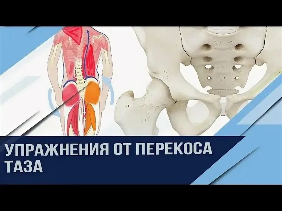 Смещен таз. Упражнения от перекоса таза. перекос таза. упражнения при перекосе таза. асимметрия таза.
